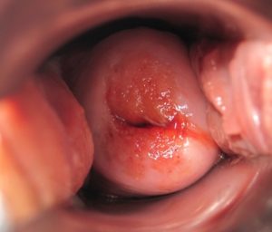 Chronic Cervical Ulcers