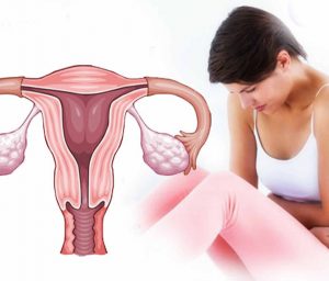 Dysfunctional Uterine Bleeding
