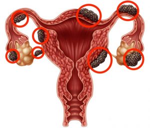 Endometriosis