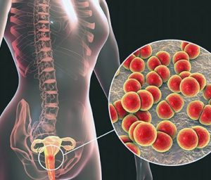 Persistent Pelvic Inflammatory Disease