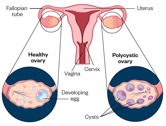 Polycystic Ovarian Syndrome